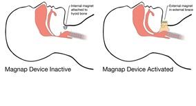 ساخت گردنبند مغناطيسي براي کنترل آپنه خواب